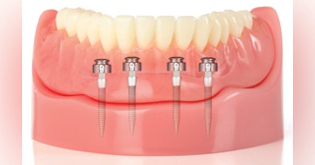 Mini Dental implants Sugar Land TX